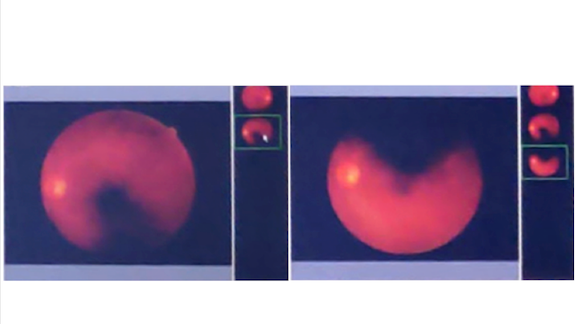Two partial images of a retina