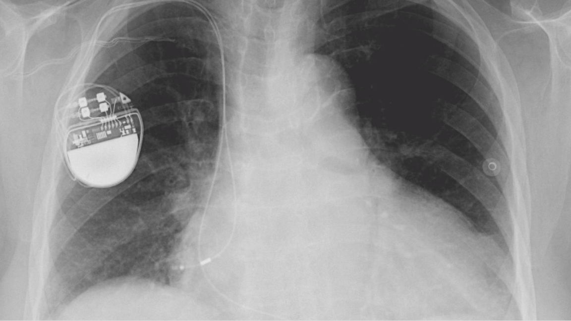 X-ray of a person with a pacemaker