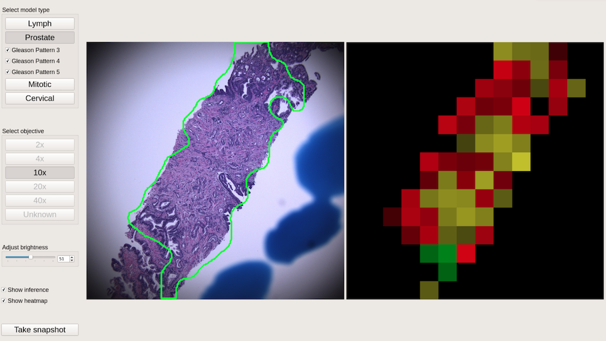 Sharper Vision for Cancer: An AI-powered microscope that helps pathologists detect cancer